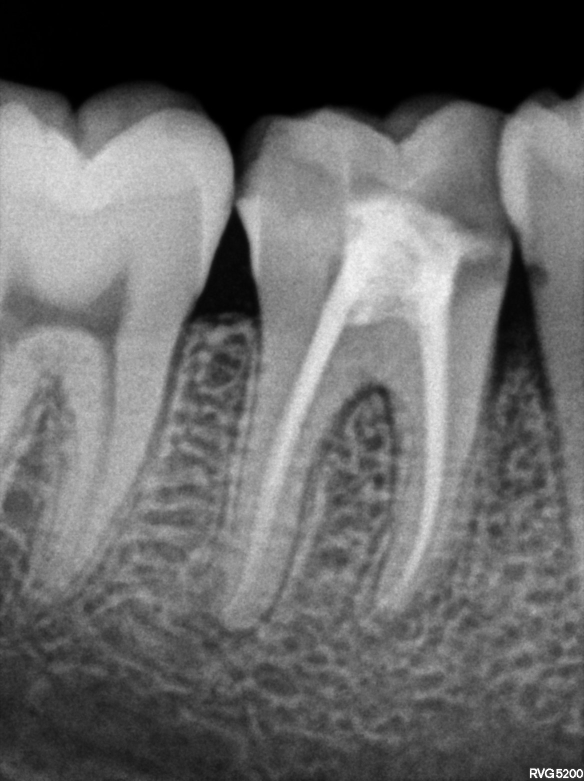 Dental X-ray